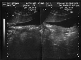 Abdominal ultrasound